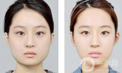 怎樣變瓜子臉？可以打*嗎？