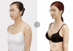 假體隆胸恢復期要多久 假體隆胸輕松擁有網(wǎng)紅傲人身材