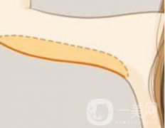 蘇州上臂吸脂減肥術一般要多少錢？