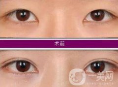 開眼角增生了能恢復(fù)嗎?開眼角會(huì)留疤嗎