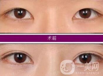 開眼角增生了能恢復(fù)嗎?開眼角會(huì)留疤嗎