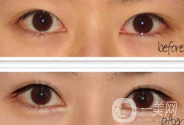 開眼角增生了能恢復(fù)嗎?開眼角會(huì)留疤嗎