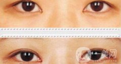 開眼角如何防止增生 開眼角輕松放大雙眼
