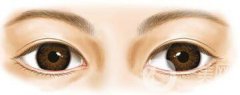 開眼角術(shù)后要眼角增生自己會(huì)消失嗎