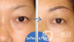 提切眉果怎么樣？提切眉手術(shù)后注意事項(xiàng)