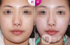 雙下巴怎么減才快速*？去雙下巴方法介紹