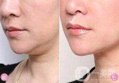 雙下巴吸脂術(shù)前準(zhǔn)備需要做哪些？