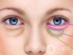 內(nèi)切祛眼袋多久恢復(fù)？