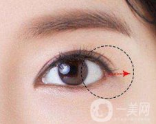 開外眼角風(fēng)險(xiǎn)大嗎？