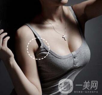 副乳切除術(shù)創(chuàng)口多大？