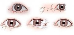 開內(nèi)眼角要多久恢復(fù) 恢復(fù)期長短和哪些因素有關(guān)