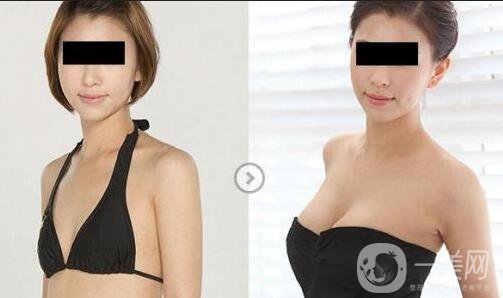 假體隆胸手術(shù)做完之后恢復(fù)期要多久時(shí)間？