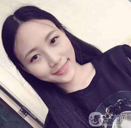 內(nèi)切去眼袋多長時間恢復 術后怎么護理