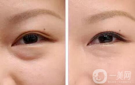 超聲波去眼袋好嗎，有哪些優(yōu)點(diǎn)？