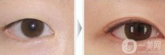 開眼角手術(shù)前后，術(shù)后果杠杠的！