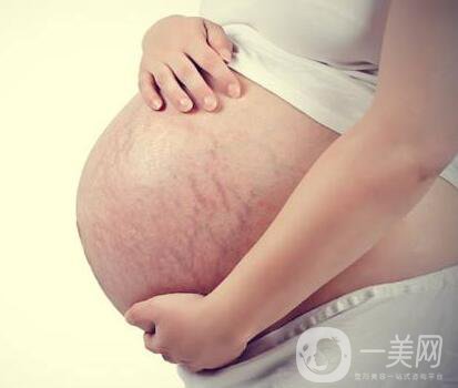 有妊娠紋怎么辦？什么方法**？