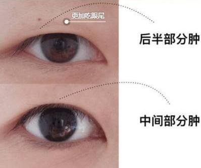眼部抽脂前后，*果*看過來！
