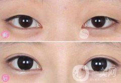 眼部手術(shù)都包含哪些項(xiàng)目？眼部手術(shù)整形多少錢