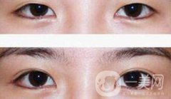 埋線雙眼皮多久消腫？幾天可以恢復(fù)自然