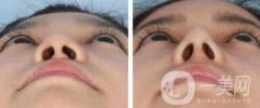 鼻小柱延長手術(shù)一般都用什么材料