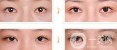 全切雙眼皮術(shù)后吃什么？術(shù)后如何護理