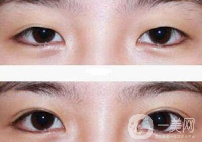 全切雙眼皮術(shù)后吃什么？術(shù)后如何護(hù)理