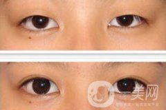 全切雙眼皮術(shù)后怎么護理？需要注意什么