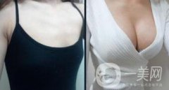 隆胸手術(shù)后多久恢復？術(shù)后注意事項有哪些