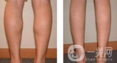 寧波射頻瘦小腿價(jià)格一般是多少錢