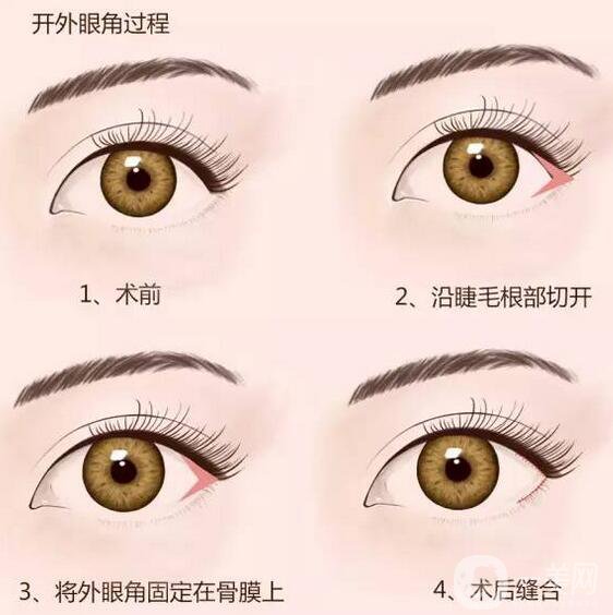 開眼角*果怎么樣？手術(shù)風(fēng)險大不大