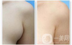 副乳是什么？副乳切除手術(shù)需要多久