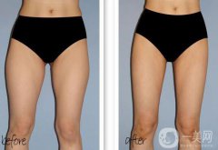 大腿吸脂多久恢復(fù)？大腿吸脂后遺癥有哪些