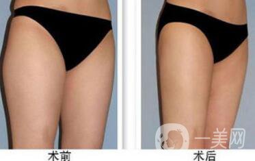 大腿吸脂多久恢復(fù)？大腿吸脂后遺癥有哪些