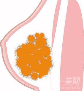 取出乳房奧美定*果怎么樣？取出*嗎？