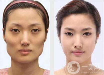 磨顴骨手術(shù)之后容易有后遺癥么？主要有哪些情況？