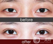 做完埋線雙眼皮手術(shù)需要注意什么