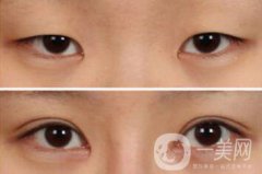 雙眼皮手術(shù)有哪些方法？做雙眼皮前要準(zhǔn)備什么