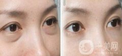 內(nèi)切祛眼袋失敗的原因 內(nèi)切祛眼袋后遺癥