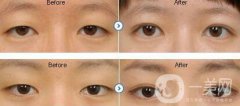 眼睛埋線后要注意什么 埋線獲得漂亮雙眼