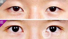 埋線雙眼皮之后禁忌有哪些？具體注意事項(xiàng)介紹
