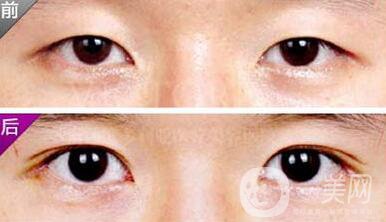 埋線雙眼皮之后禁忌有哪些？具體注意事項介紹