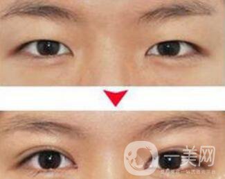 埋線雙眼皮之后禁忌有哪些？具體注意事項介紹