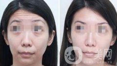 抬頭紋能消除嗎？用什么方法祛除抬頭紋