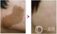 深圳做c6激光祛斑多少錢一次