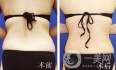 背部吸脂前后注意事項(xiàng)具體有哪些