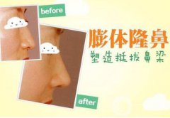 膨體隆鼻后期果怎么樣呢?果圖有嗎？