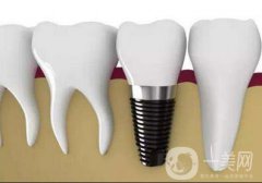 登騰在醫(yī)院轉(zhuǎn)做種植牙需要多少錢 價(jià)格影響因素有哪些