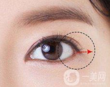 開眼角手術(shù)術(shù)前檢查什么？