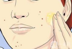 怎么去痘印？去痘印方法有哪些？