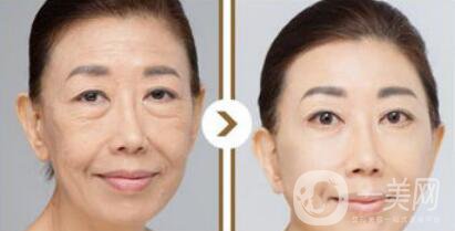 塑美極*果怎么樣？塑美極的副作用